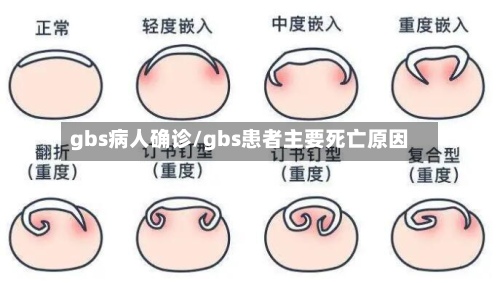 gbs病人确诊/gbs患者主要死亡原因