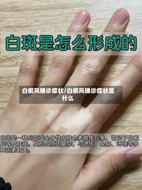 白癜风确诊症状/白癜风确诊症状是什么-第2张图片