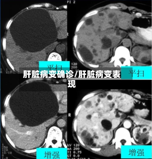 肝脏病变确诊/肝脏病变表现-第2张图片