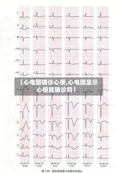 【心电图确诊心梗,心电图显示心梗能确诊吗】-第2张图片