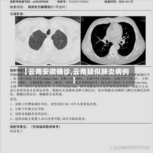 【云南安徽确诊,云南疑似肺炎病例】